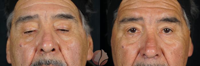Before & After Ptosis - Men 70's Case 144 Front View in Saratoga, CA