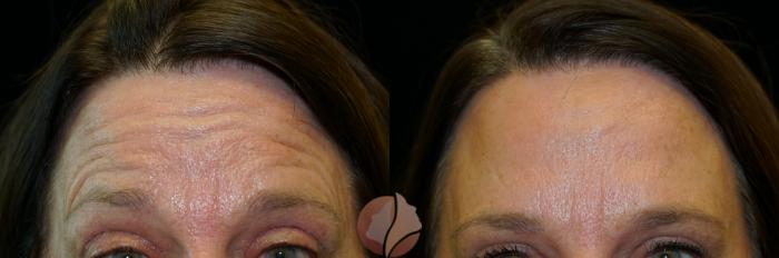 Before & After BOTOX® Cosmetic & Dysport® Case 92 Front View in Saratoga, CA