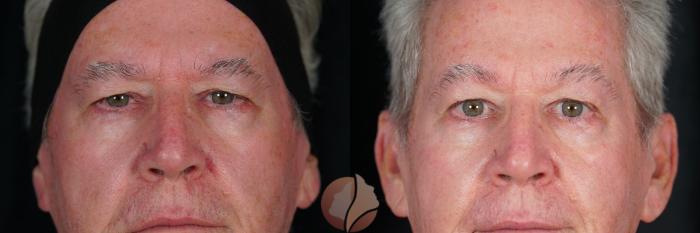 Before & After Brow Lift Case 126 Front View in Saratoga, CA