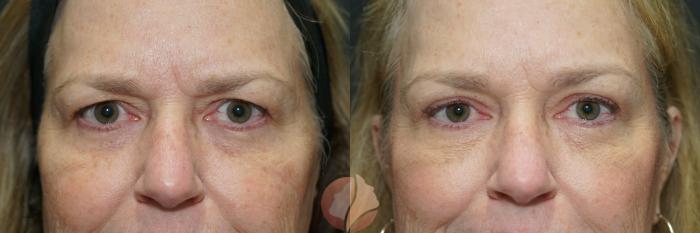 Before & After Brow Lift Case 128 Front View in Saratoga, CA