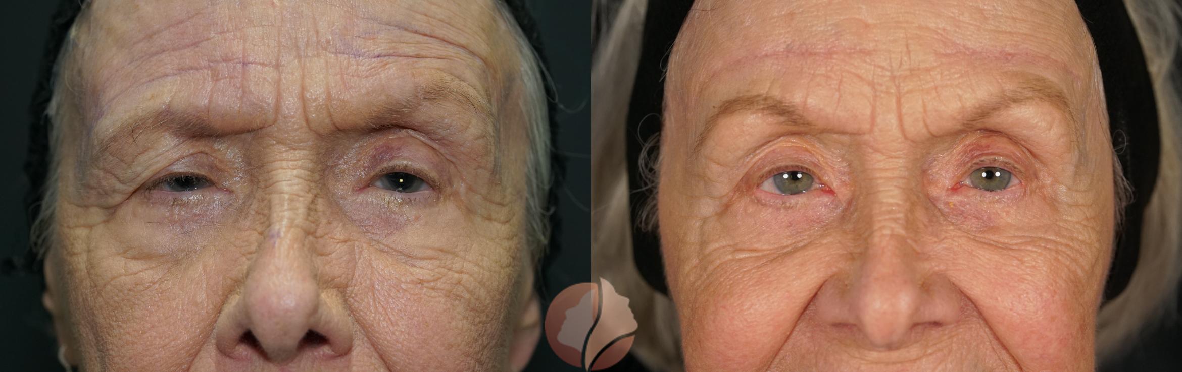 Before & After Brow Lift Case 129 Front View in Saratoga, CA