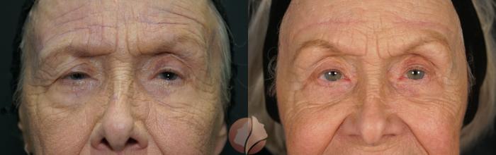 Before & After Ptosis Women - 80's Case 129 Front View in Saratoga, CA