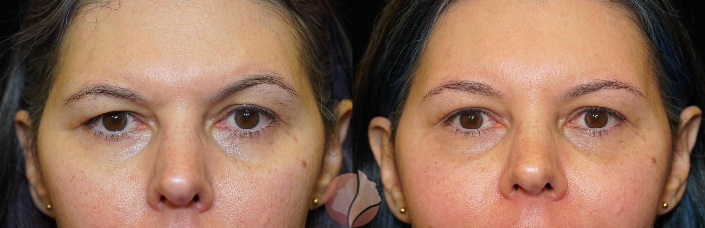 Before & After Brow Lift Case 14 Front View in Saratoga, CA