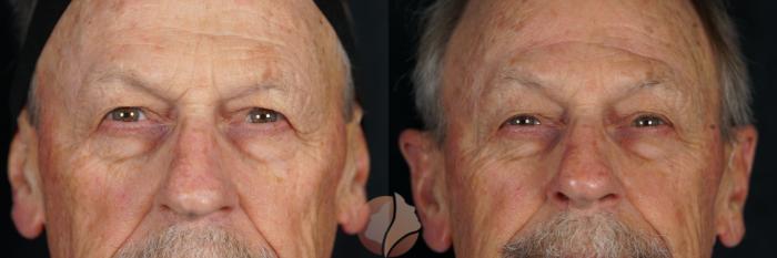 Before & After Brow Lift Case 149 Front View in Saratoga, CA