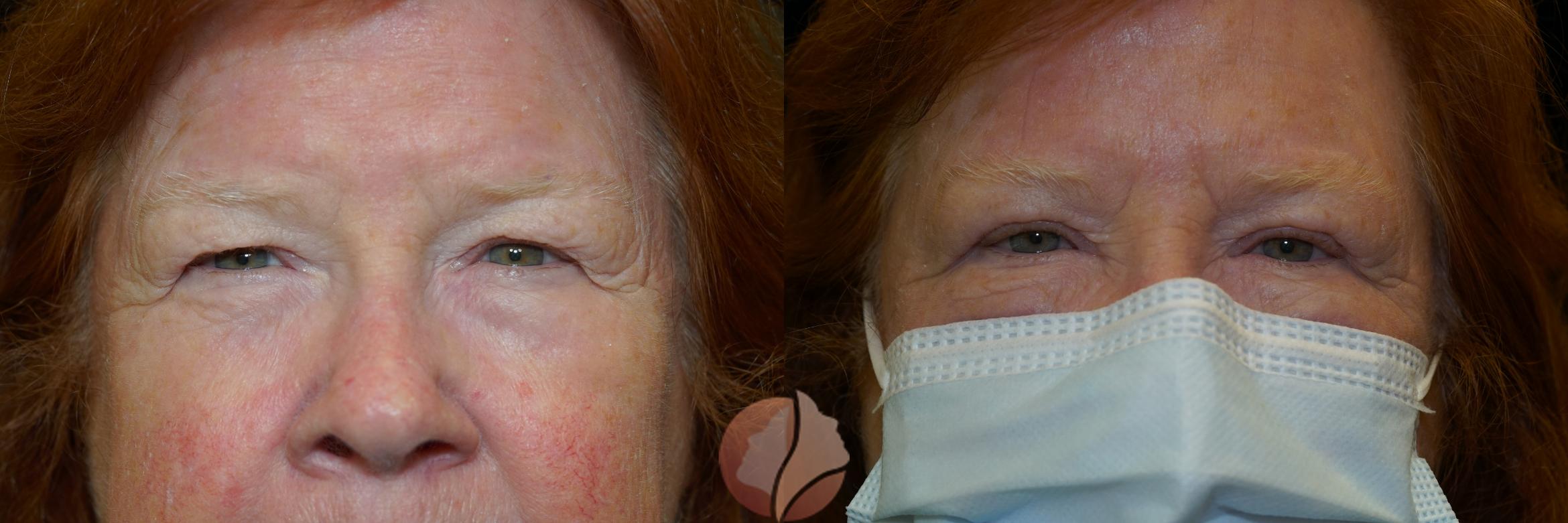 Before & After Brow Lift Case 15 Front View in Saratoga, CA