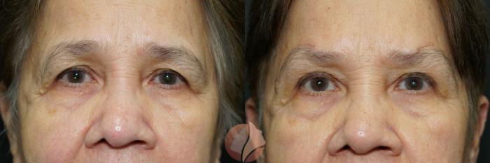 Before & After Brow Lift Case 16 Front View in Saratoga, CA