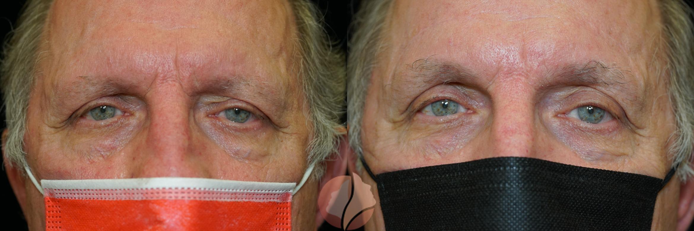 Before & After Brow Lift Case 17 Front View in Saratoga, CA