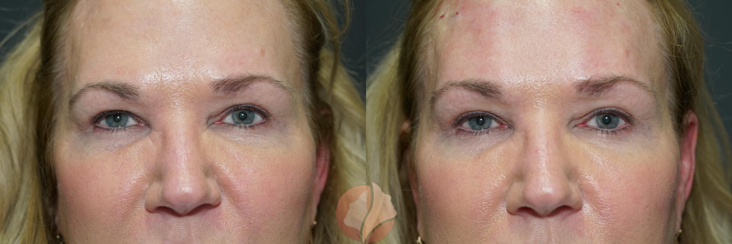 Before & After Brow Lift Case 7 Front View in Saratoga, CA