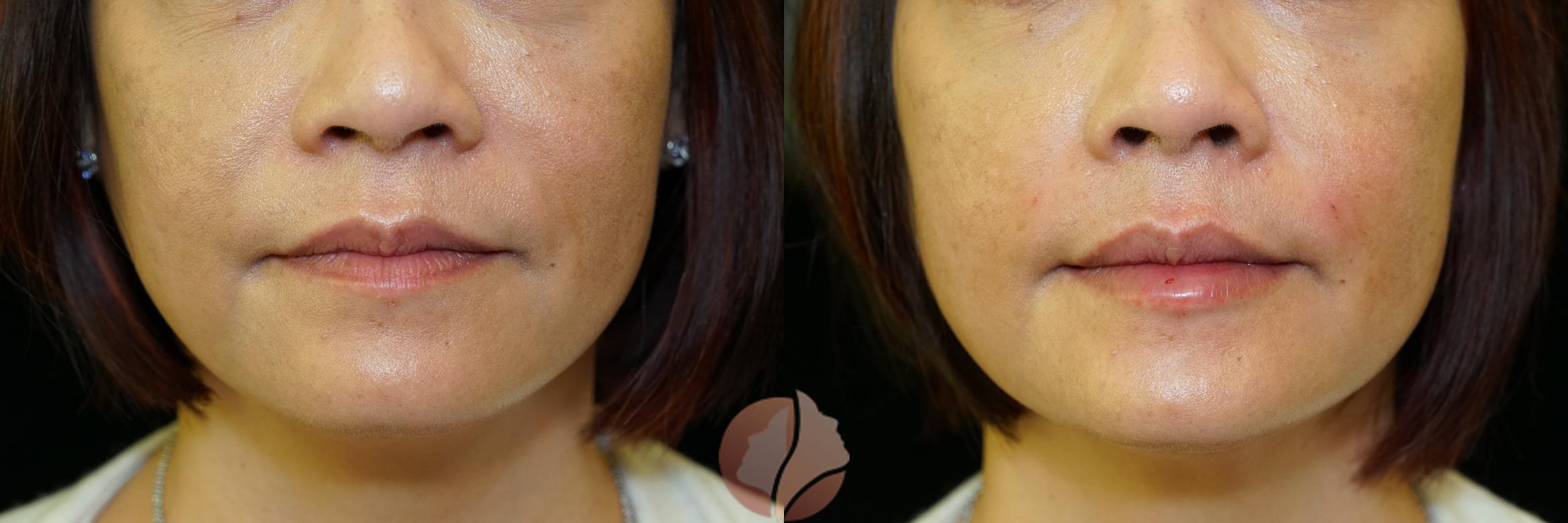 Before & After Dermal Fillers Case 100 Front View in Saratoga, CA