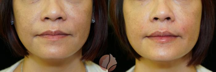 Before & After Dermal Fillers Case 100 Front View in Saratoga, CA