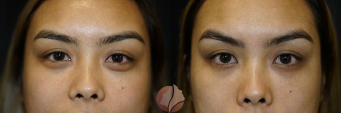 Before & After Dermal Fillers Case 101 Front View in Saratoga, CA