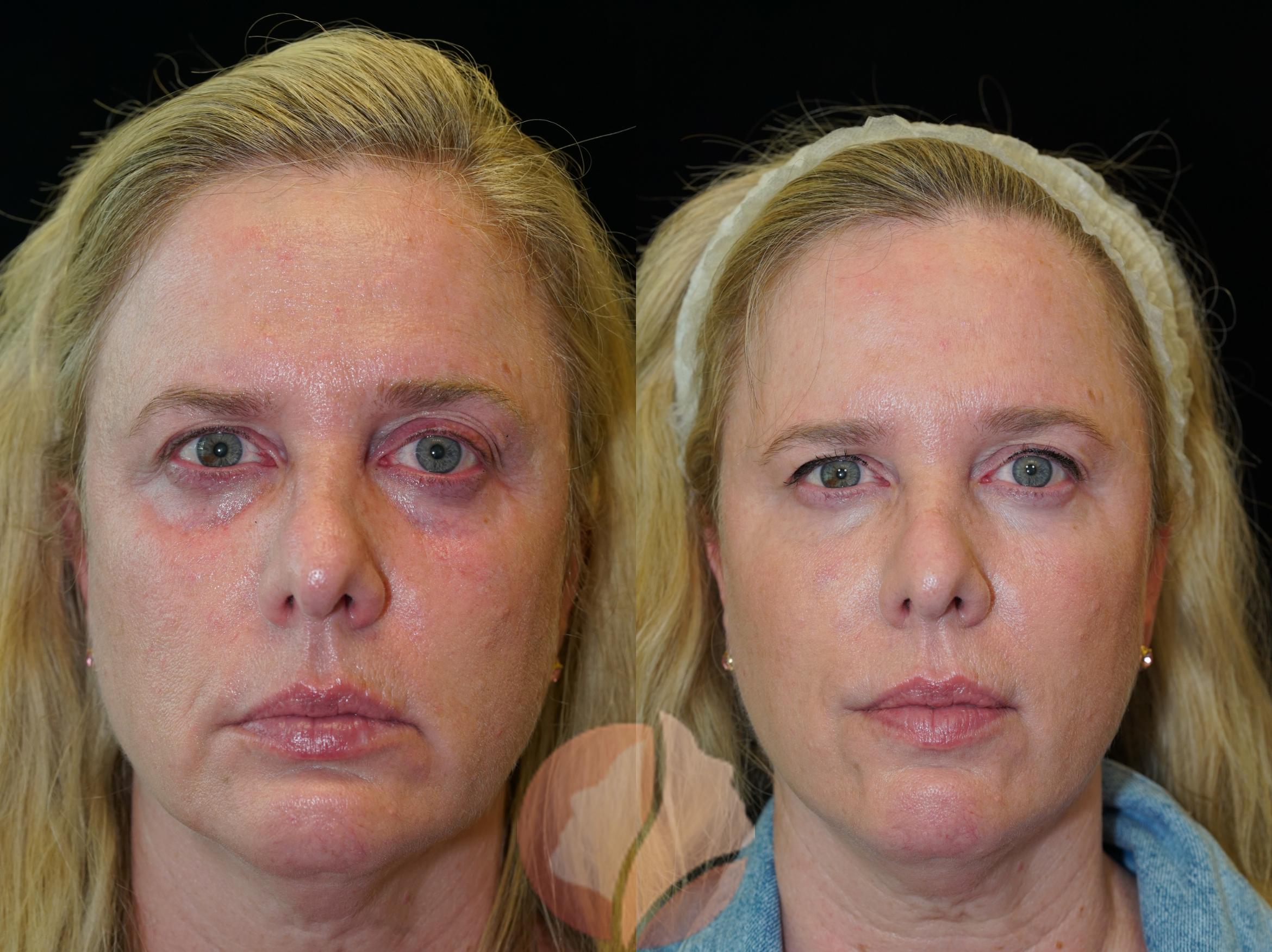 Before & After Dermal Fillers Case 102 Front View in Saratoga, CA