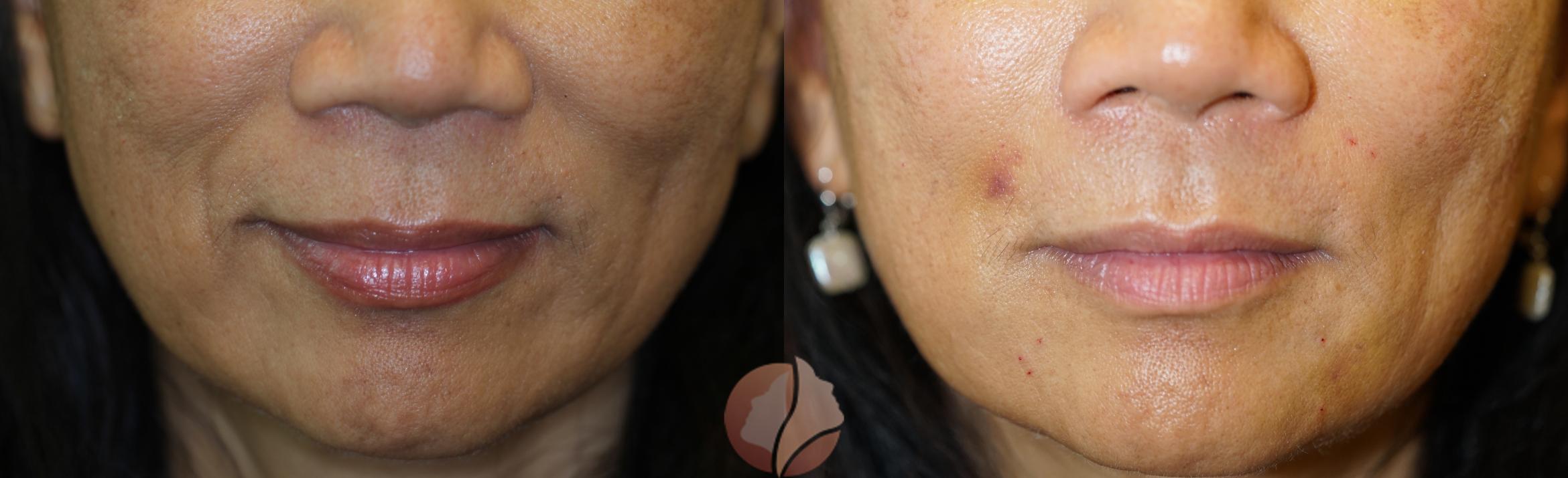 Before & After Dermal Fillers Case 103 Front View in Saratoga, CA