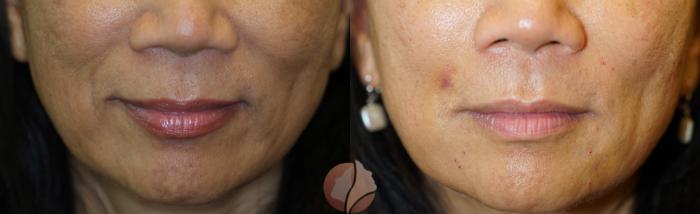 Before & After Dermal Fillers Case 103 Front View in Saratoga, CA