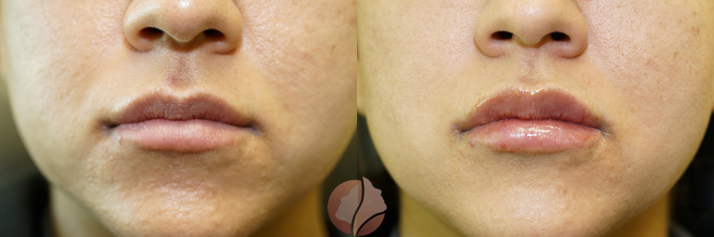 Before & After Dermal Fillers Case 104 Front View in Saratoga, CA