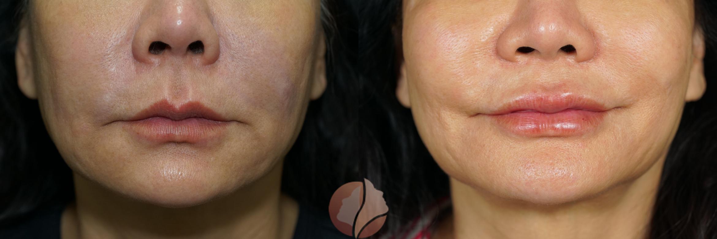 Before & After Dermal Fillers Case 70 Front View in Saratoga, CA