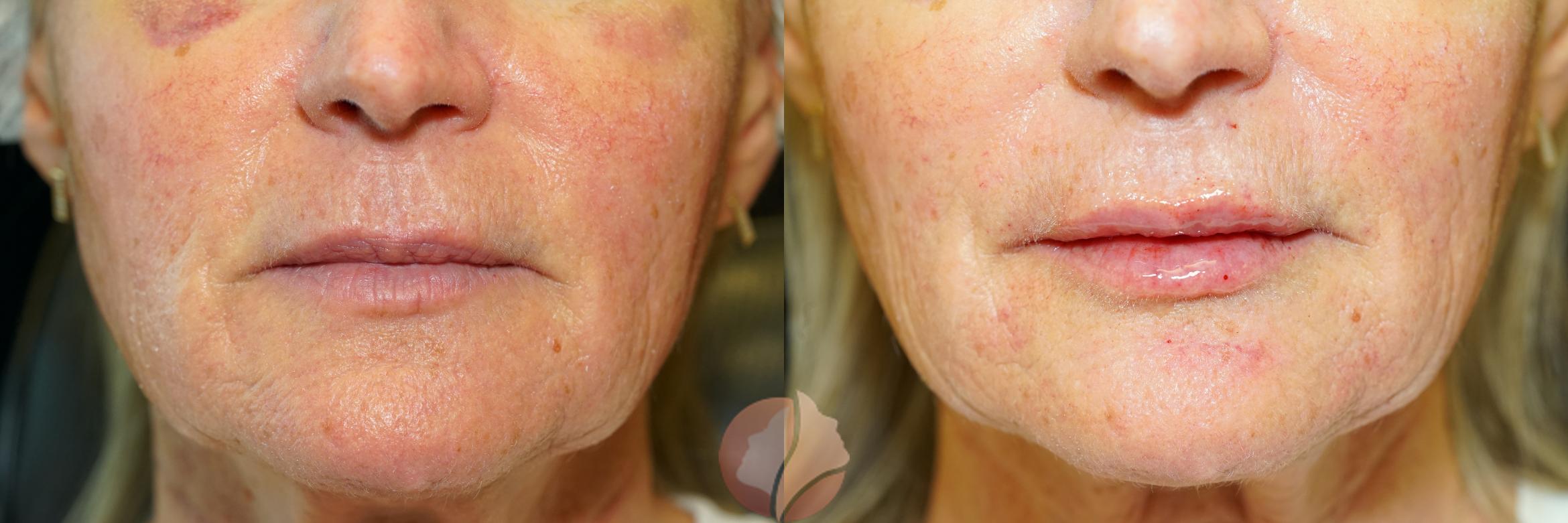 Before & After Dermal Fillers Case 75 Front View in Saratoga, CA