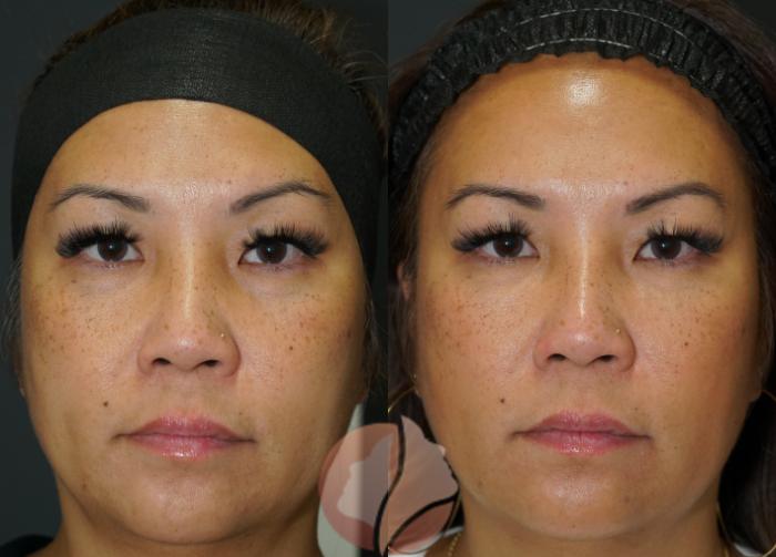 Before & After Dermal Fillers Case 93 Front View in Saratoga, CA