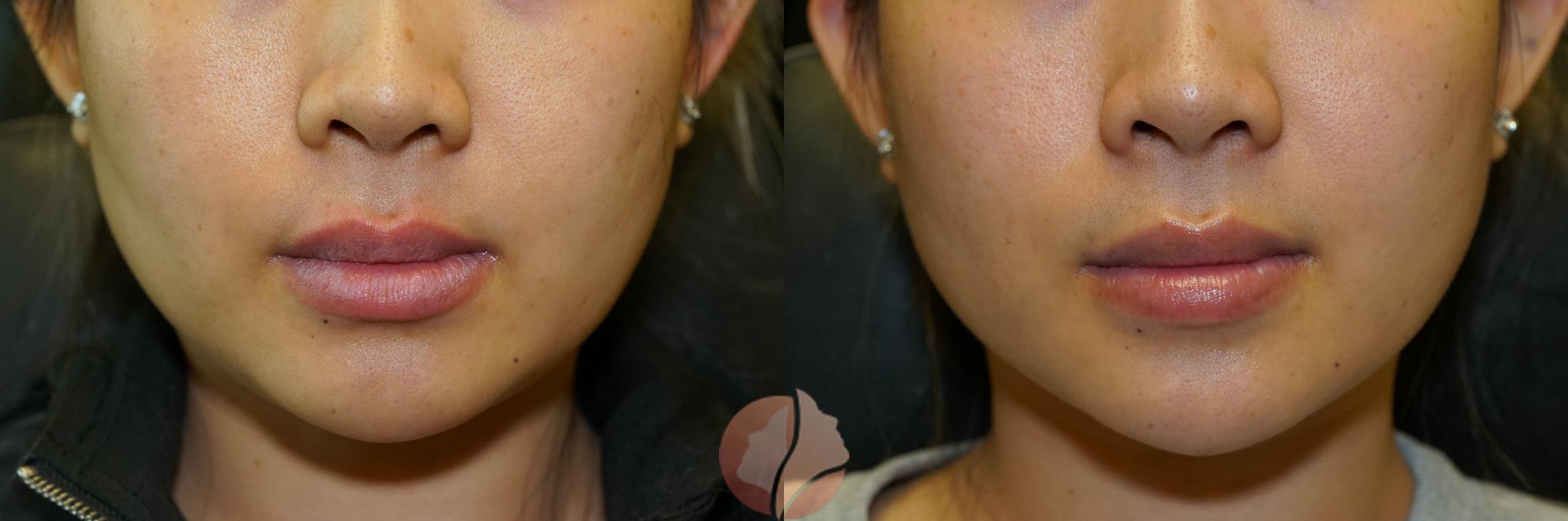 Before & After Dermal Fillers Case 94 Front View in Saratoga, CA