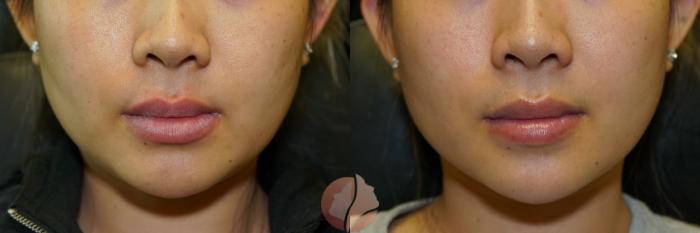 Before & After Dermal Fillers Case 94 Front View in Saratoga, CA