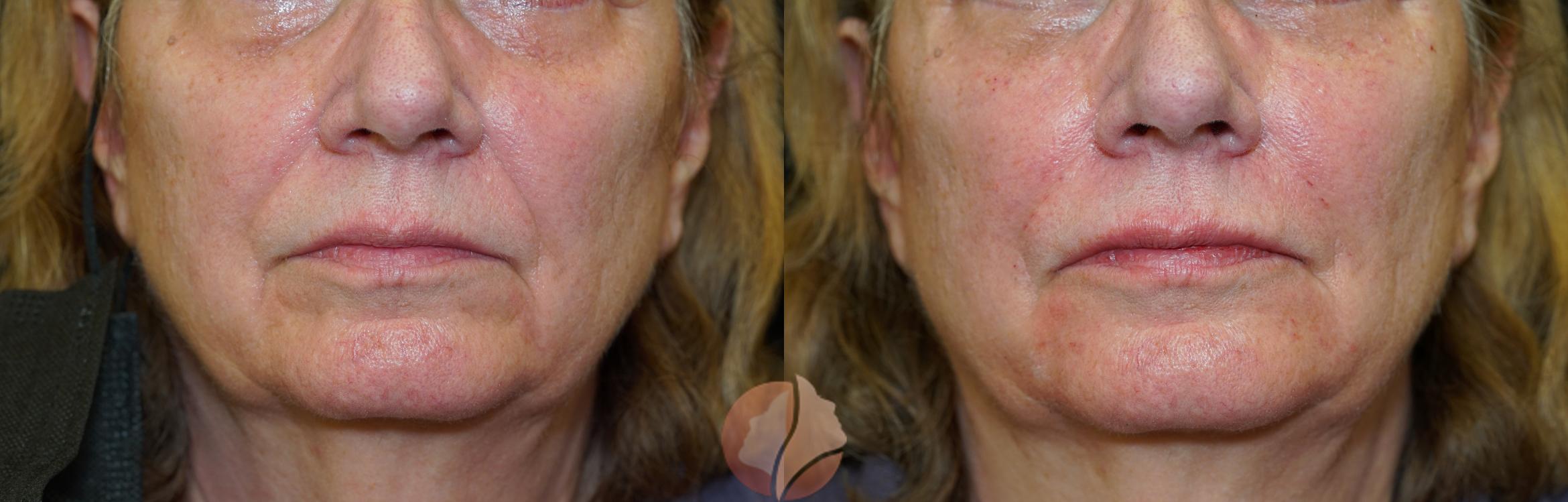 Before & After Dermal Fillers Case 95 Front View in Saratoga, CA