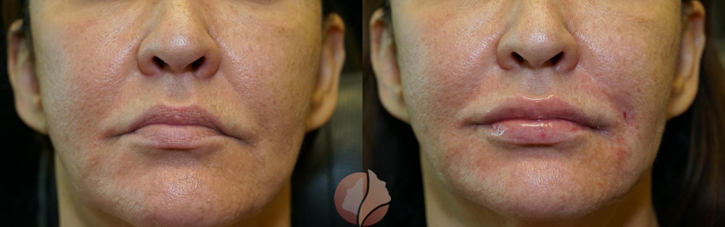 Before & After Dermal Fillers Case 96 Front View in Saratoga, CA