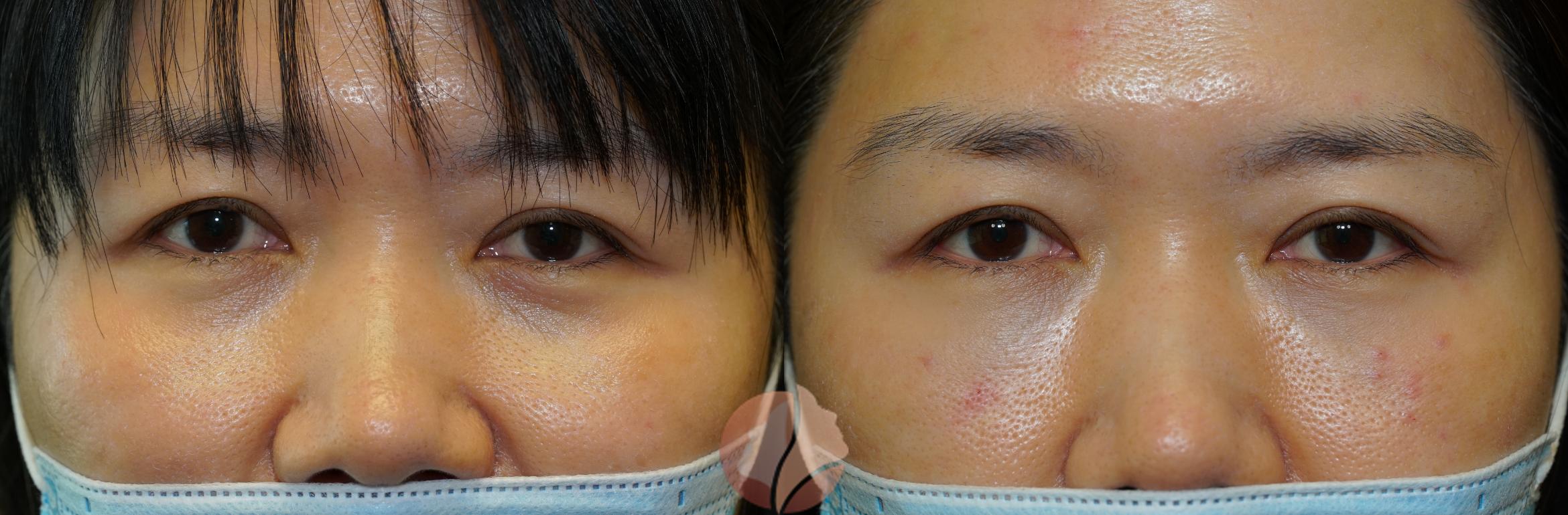 Before & After Dermal Fillers Case 97 Front View in Saratoga, CA