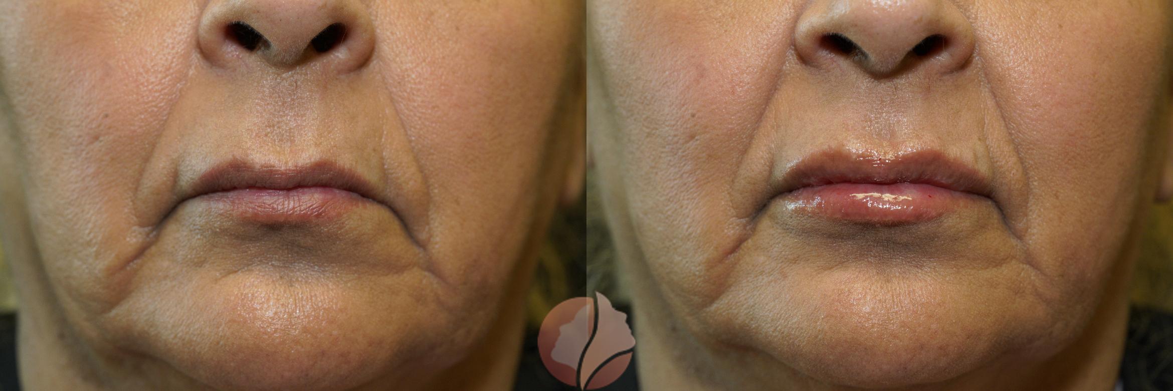 Before & After Dermal Fillers Case 98 Front View in Saratoga, CA