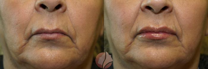 Before & After Dermal Fillers Case 98 Front View in Saratoga, CA