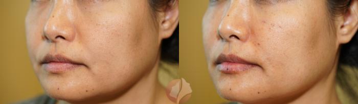 Before & After Dermal Fillers Case 99 Left Side View in Saratoga, CA