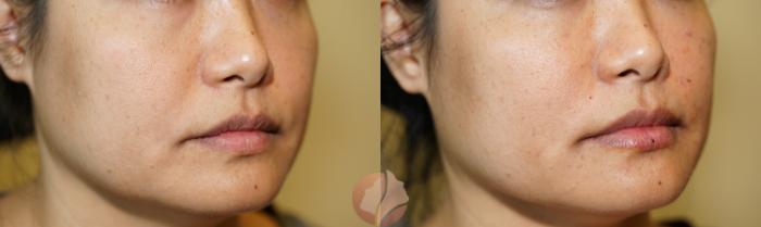 Before & After Dermal Fillers Case 99 Right Side View in Saratoga, CA