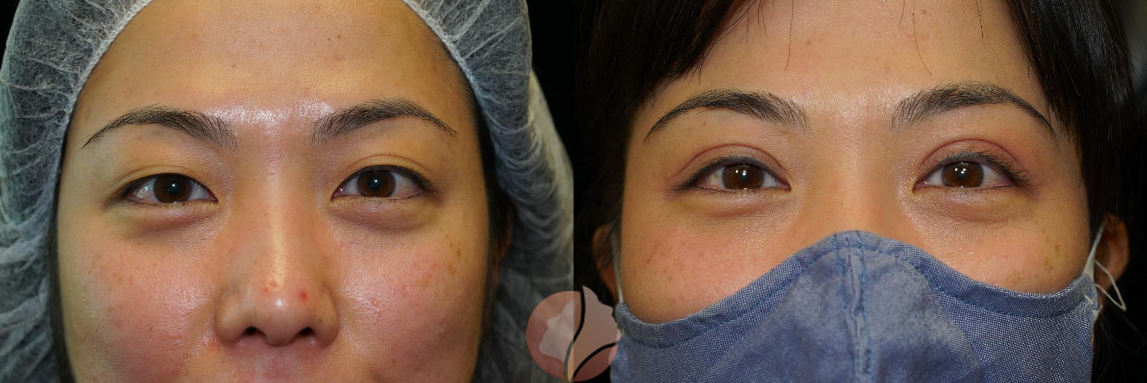 Before & After Double Eyelid Surgery Case 1 Front View in Saratoga, CA