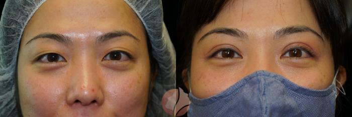 Before & After Double Eyelid Surgery Case 1 Front View in Saratoga, CA