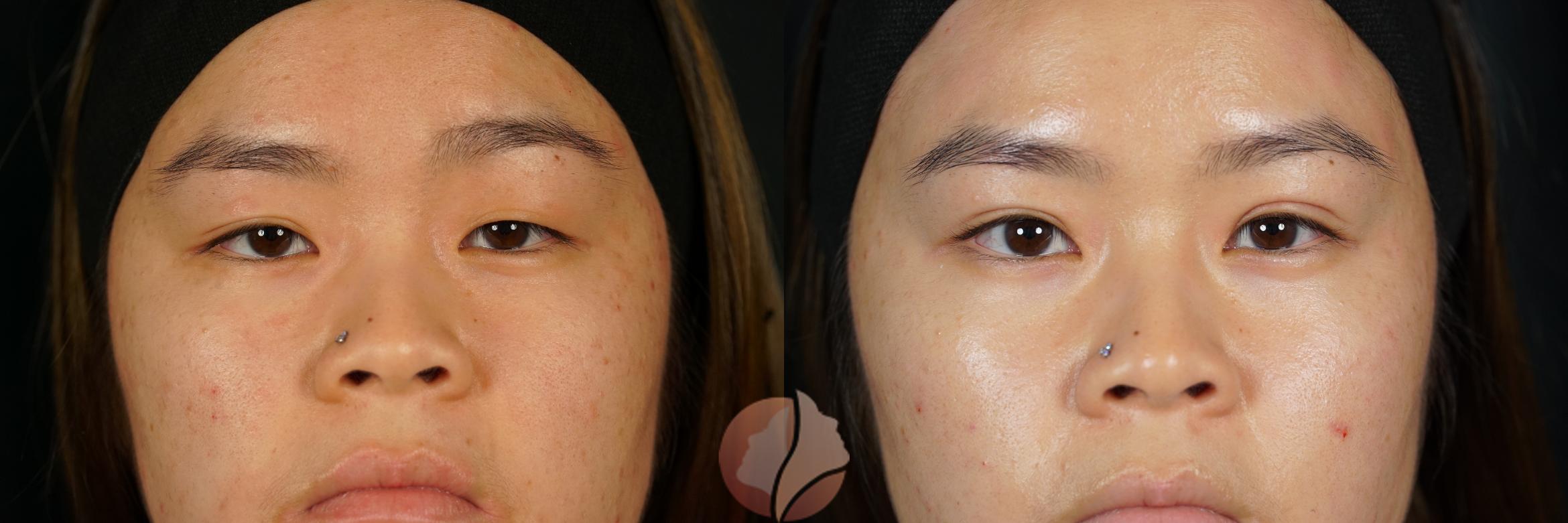 Before & After Double Eyelid Surgery Case 123 Front View in Saratoga, CA