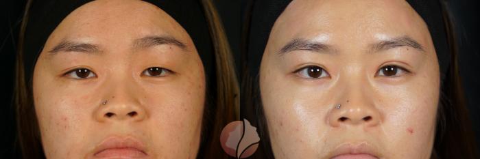 Before & After Double Eyelid Surgery Case 123 Front View in Saratoga, CA