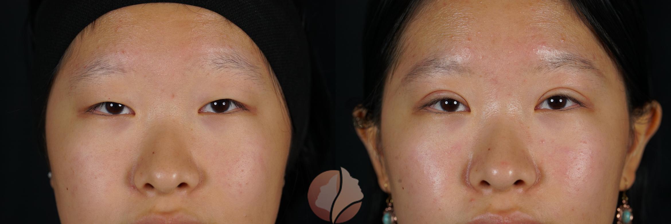 Before & After Double Eyelid Surgery Case 124 Front View in Saratoga, CA