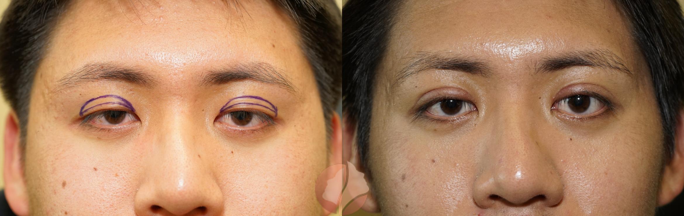 Before & After Double Eyelid Surgery Case 125 Front View in Saratoga, CA