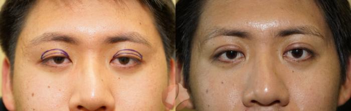 Before & After Double Eyelid Surgery Case 125 Front View in Saratoga, CA