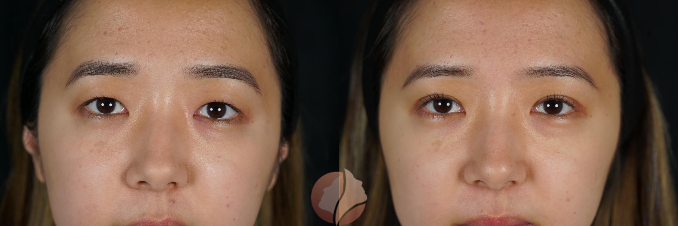 Before & After Double Eyelid Surgery Case 132 Front View in Saratoga, CA