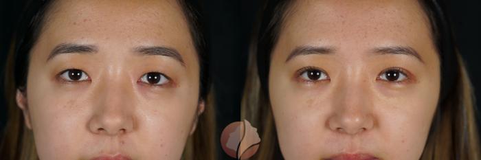 Before & After Double Eyelid Surgery Case 132 Front View in Saratoga, CA