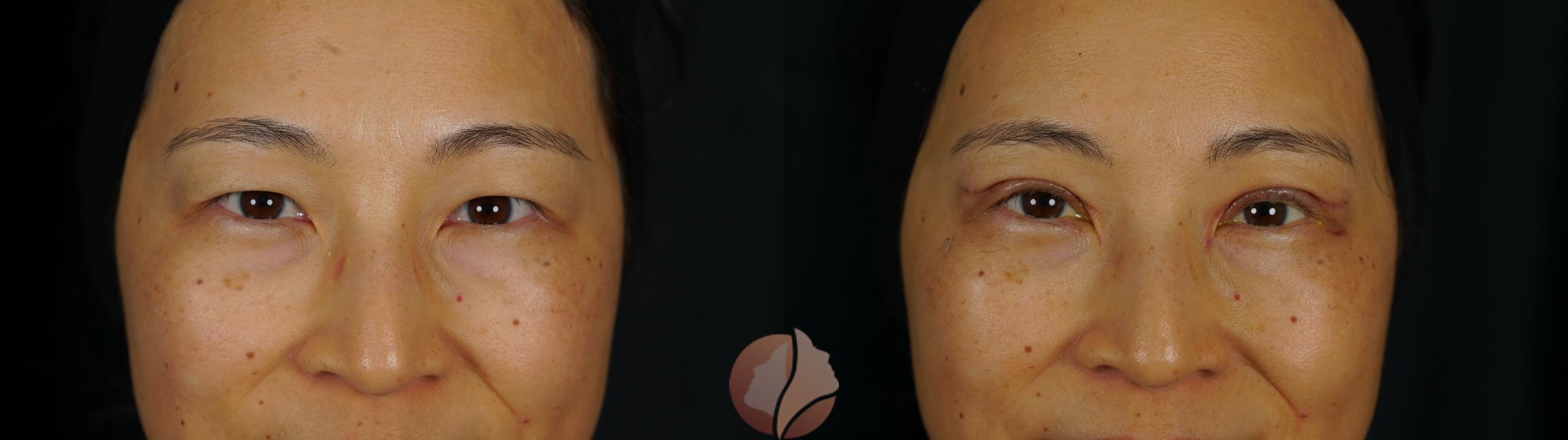 Before & After Double Eyelid Surgery Case 151 Front View in Saratoga, CA