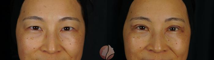 Before & After Double Eyelid Surgery Case 151 Front View in Saratoga, CA