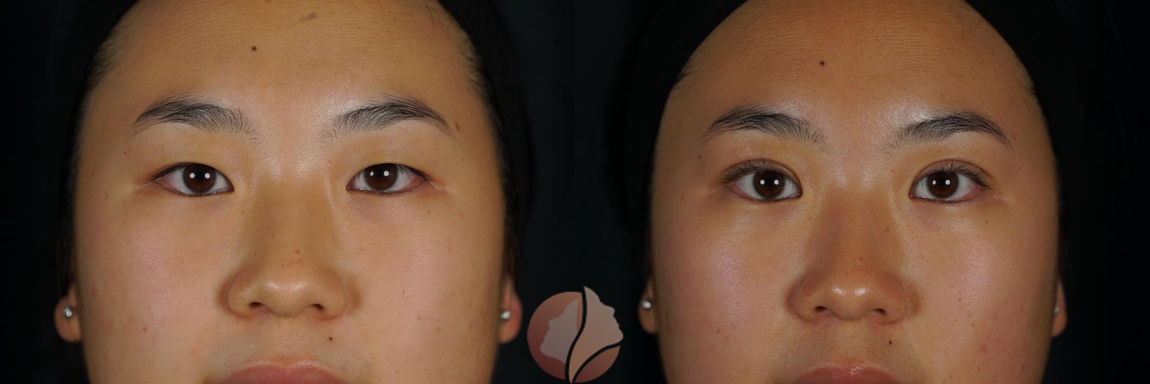 Before & After Double Eyelid Surgery Case 152 Front View in Saratoga, CA
