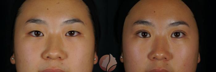 Before & After Double Eyelid Surgery Case 152 Front View in Saratoga, CA