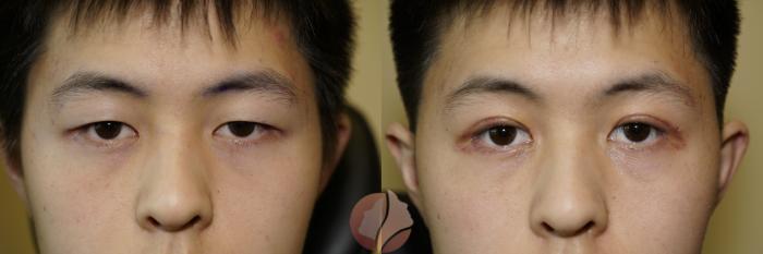 Before & After Double Eyelid Surgery Case 2 Front View in Saratoga, CA