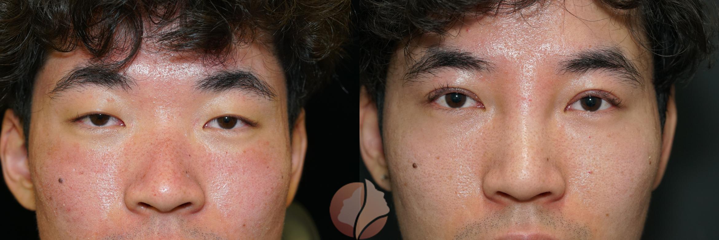 Before & After Double Eyelid Surgery Case 3 Front View in Saratoga, CA