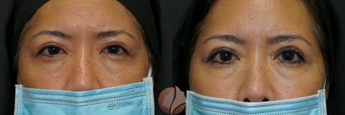 Before & After Double Eyelid Surgery Case 4 Front View in Saratoga, CA