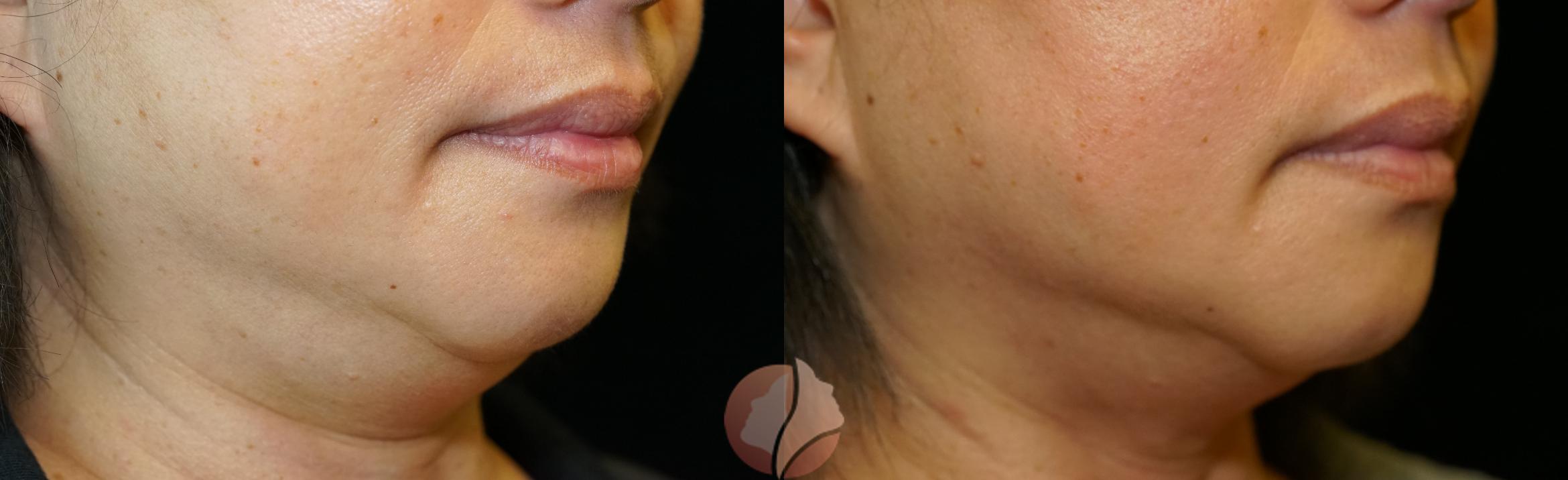 Before & After FaceTite Case 51 Right Side View in Saratoga, CA