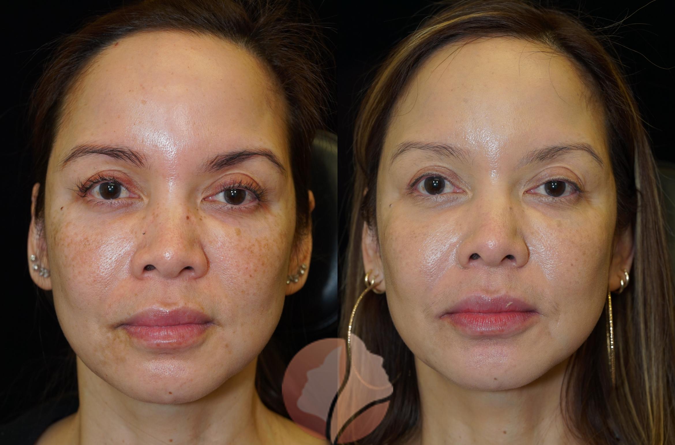 Before & After LaFace Skin Brightening System Case 11 Front View in Saratoga, CA