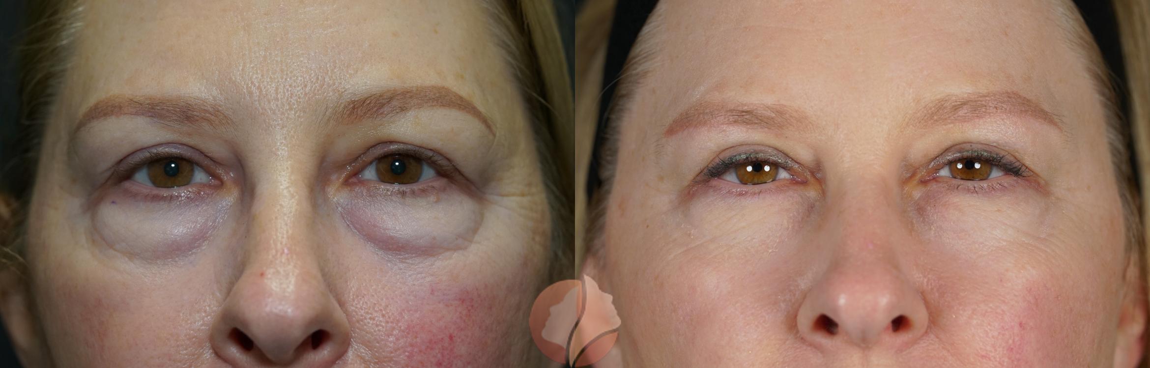 Bilateral upper lid blepharoplasty